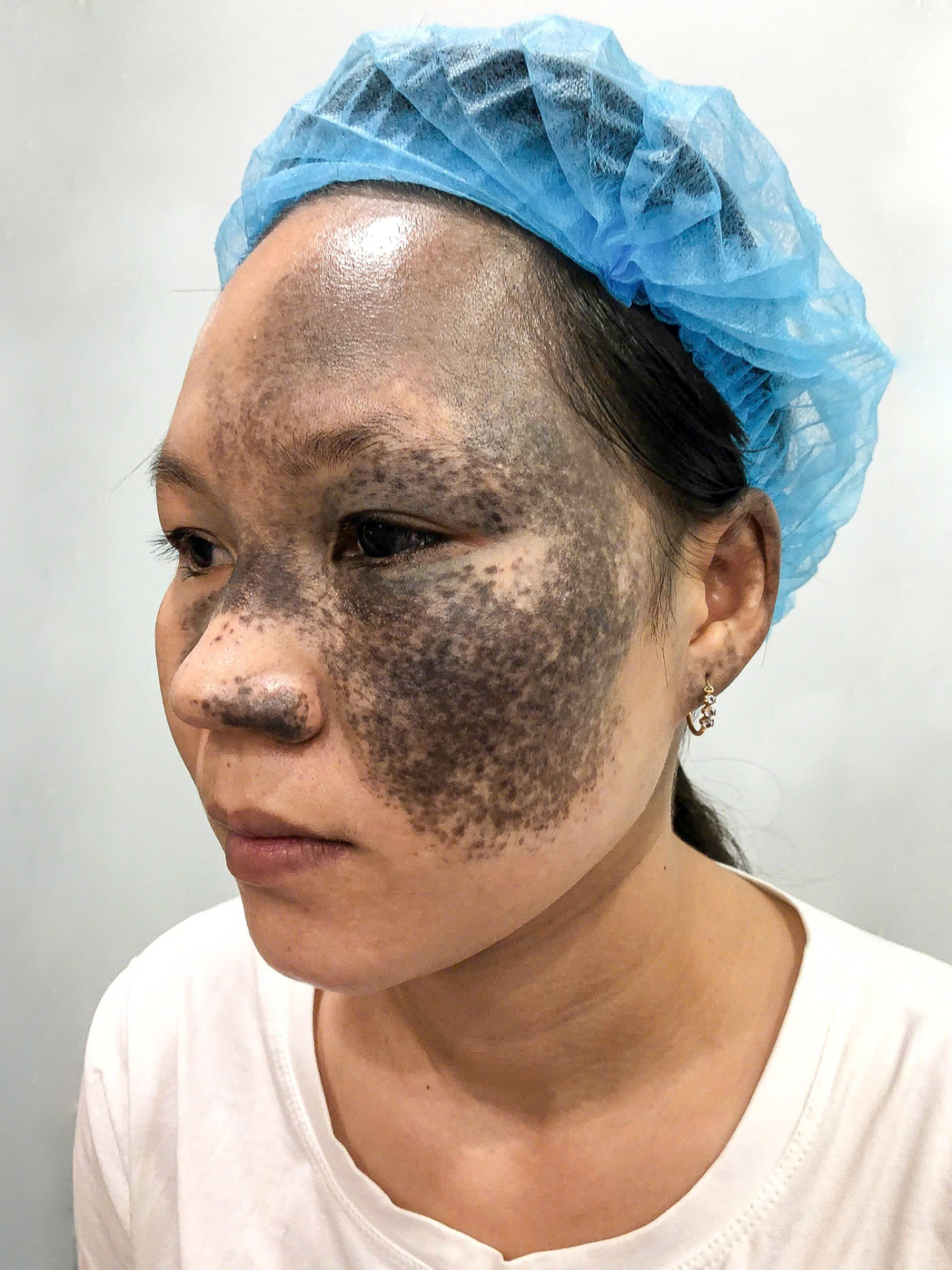 B&iacute;ch Bi ng&agrave;y đầu đến với Thẩm mỹ Ho&agrave;ng Tuấn (Dr. Ho&agrave;n Tuấn)