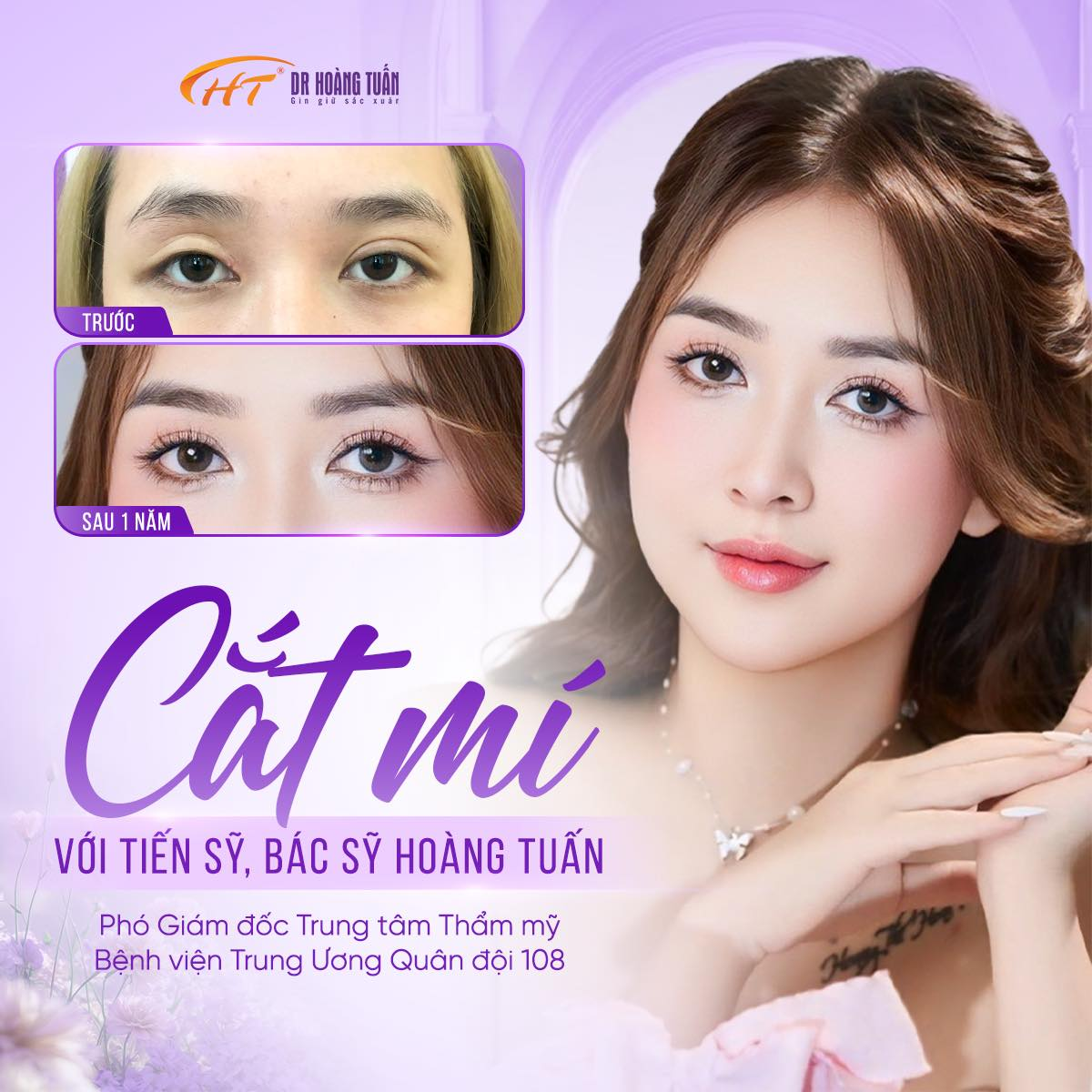 Cắt mí hay nhấn mí tốt hơn? Bác sĩ phân tích để bạn chọn đúng ngay lần đầu