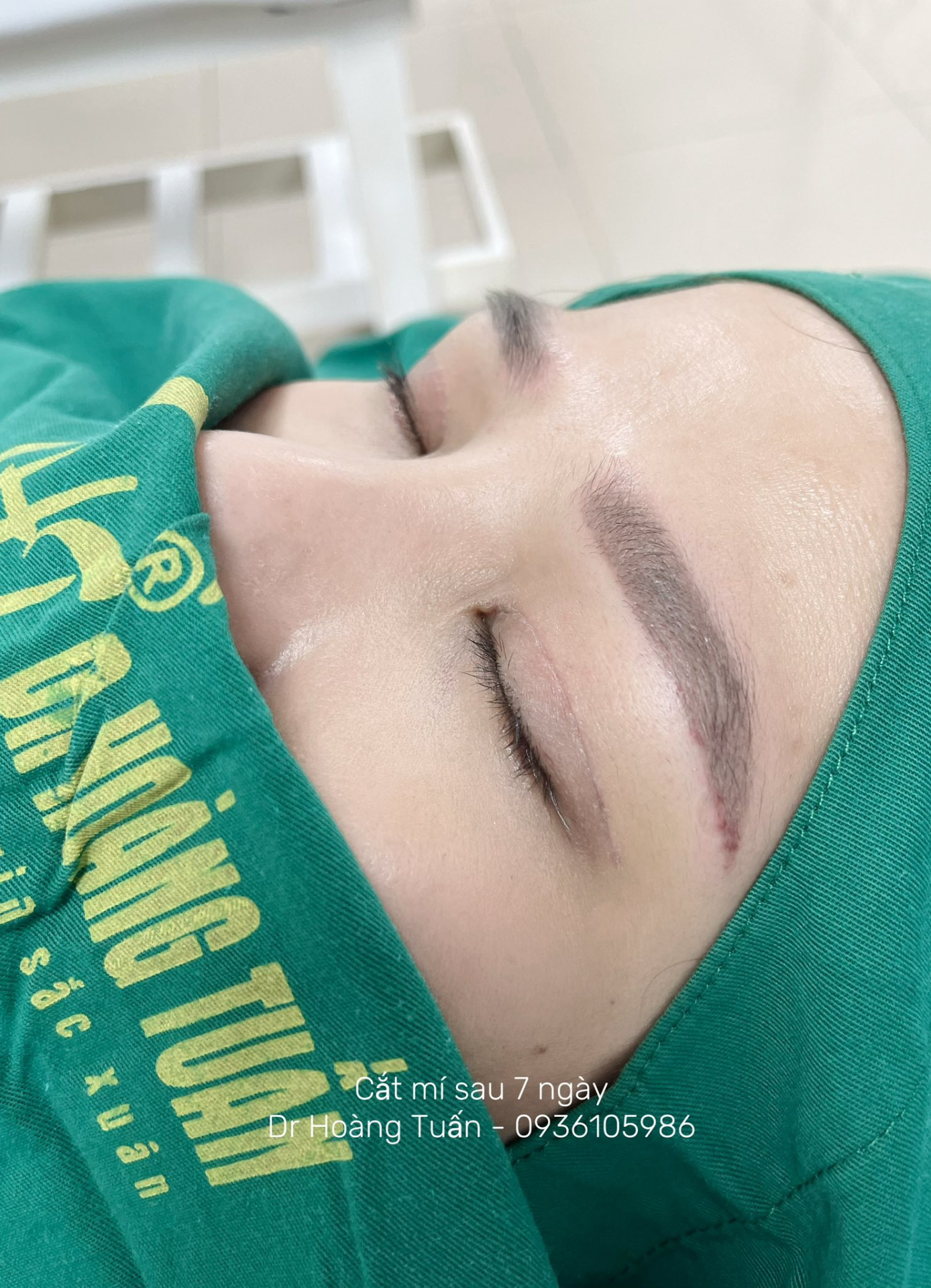 Cắt m&iacute; mắt c&oacute; để lại sẹo kh&ocirc;ng? Giải đ&aacute;p chi tiết trước khi bạn quyết định phẫu thuật