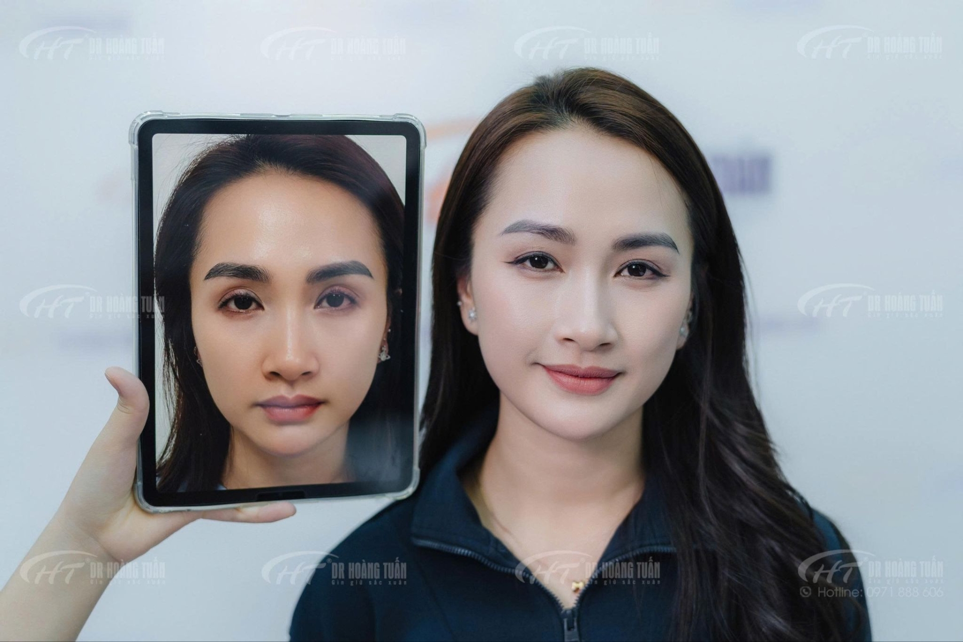 Ghép mỡ mí mắt có an toàn không? Giải thích từ chuyên gia thẩm mỹ mắt để bạn hiểu đúng trước khi làm