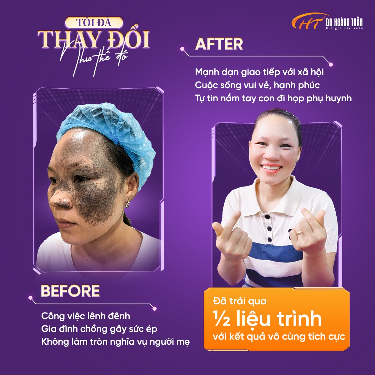 H&agrave;nh tr&igrave;nh t&ocirc;i đ&atilde; thay đổi như thế đ&oacute; tại Thẩm mỹ Ho&agrave;ng Tuấn (Dr. Ho&agrave;ng Tuấn)