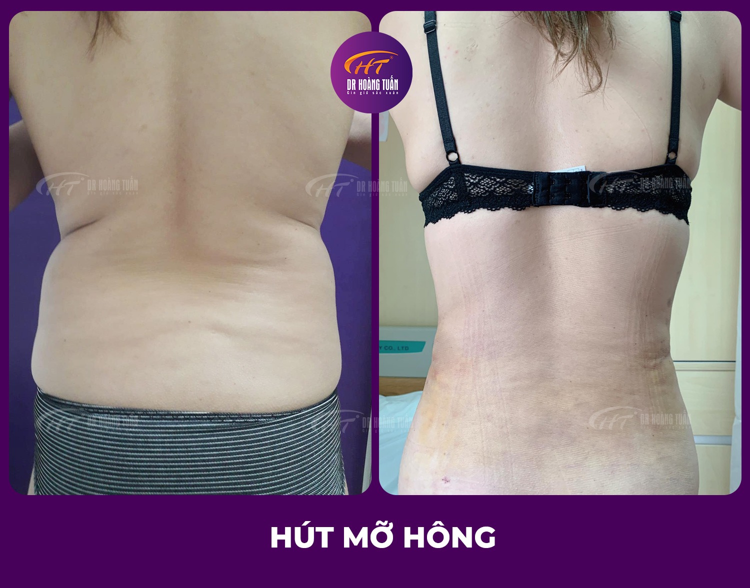 H&uacute;t mỡ 2 b&ecirc;n h&ocirc;ng: Giải ph&aacute;p &ldquo;siết eo&rdquo; gi&uacute;p d&aacute;ng thon gọn nhanh ch&oacute;ng