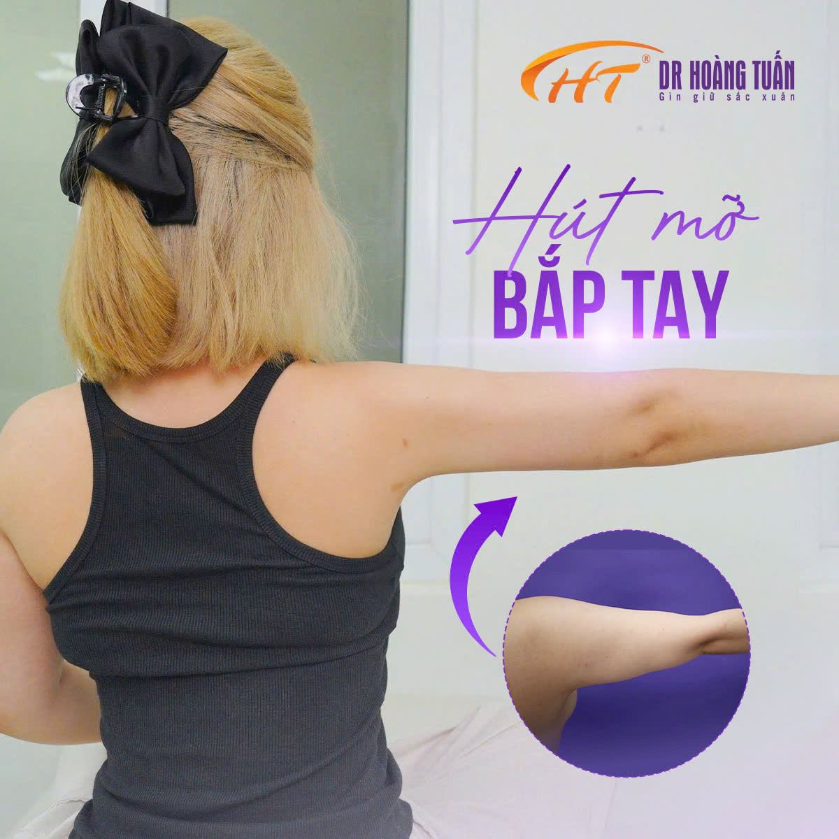 H&uacute;t mỡ bắp tay ki&ecirc;ng ăn g&igrave;? Giải đ&aacute;p từ chuy&ecirc;n gia H&uacute;t mỡ Dr Ho&agrave;ng Tuấn