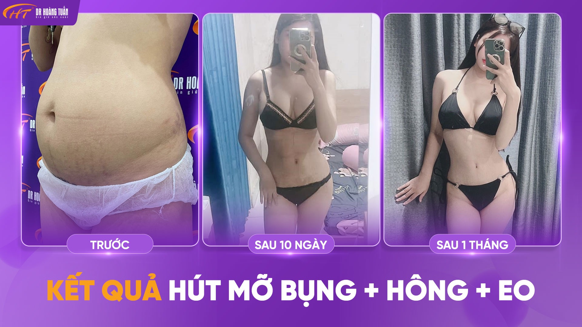 Hút mỡ bụng có tốt không? Lưu ý gì trước và sau khi hút mỡ