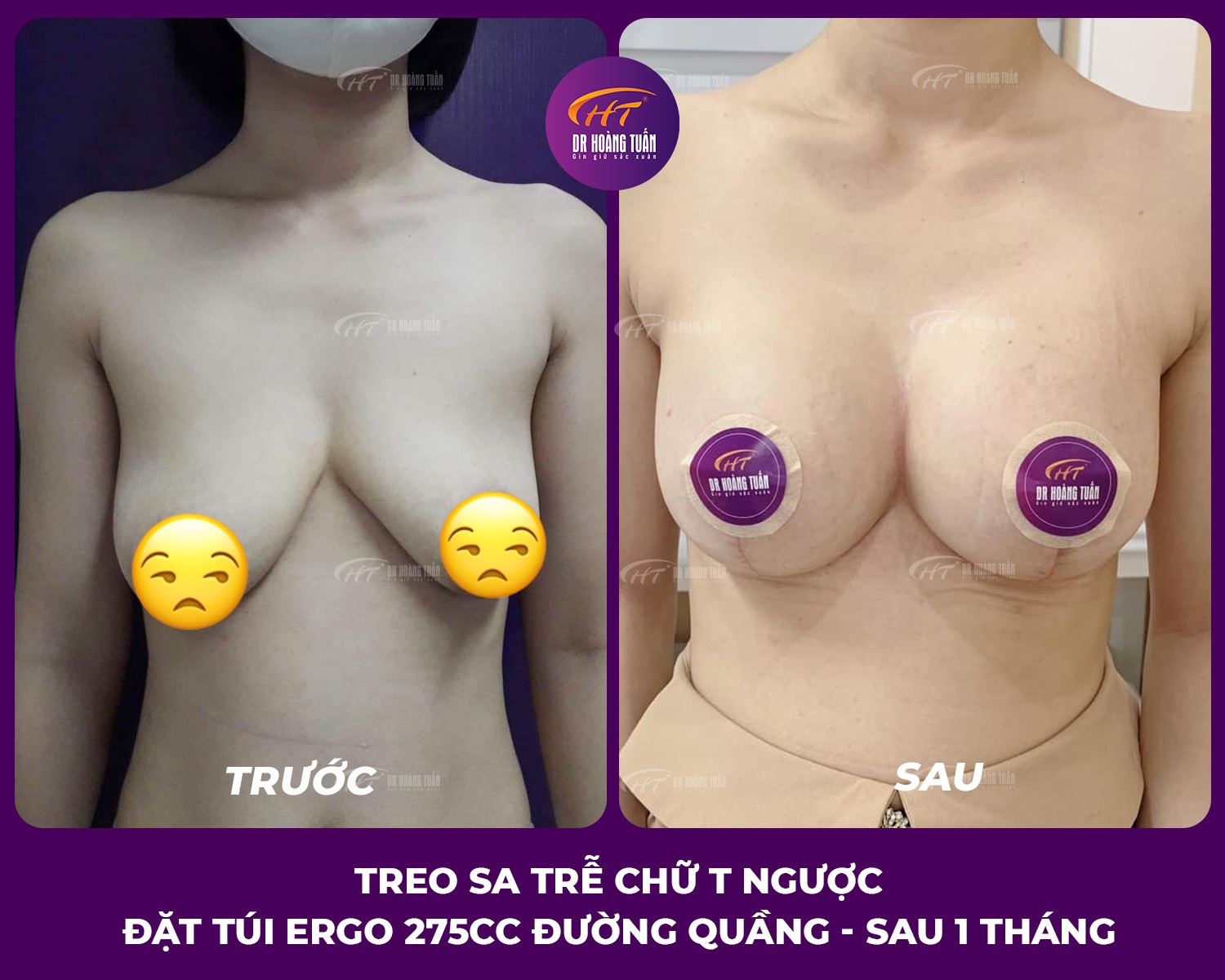 Nâng ngực chảy xệ sau sinh giá bao nhiêu? Giải đáp chi tiết theo từng mức độ sa trễ