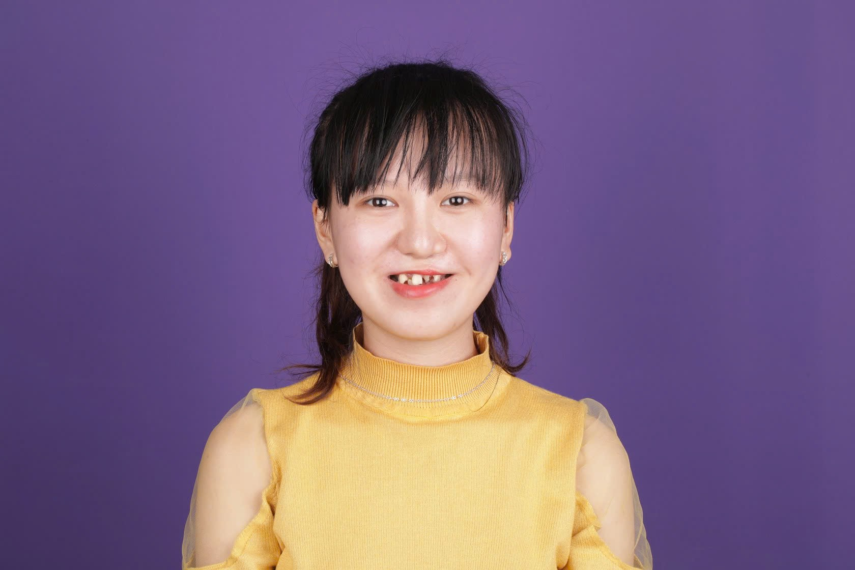 Người b&igrave;nh thường
Khiếm khuyết bẩm sinh
Nụ cười