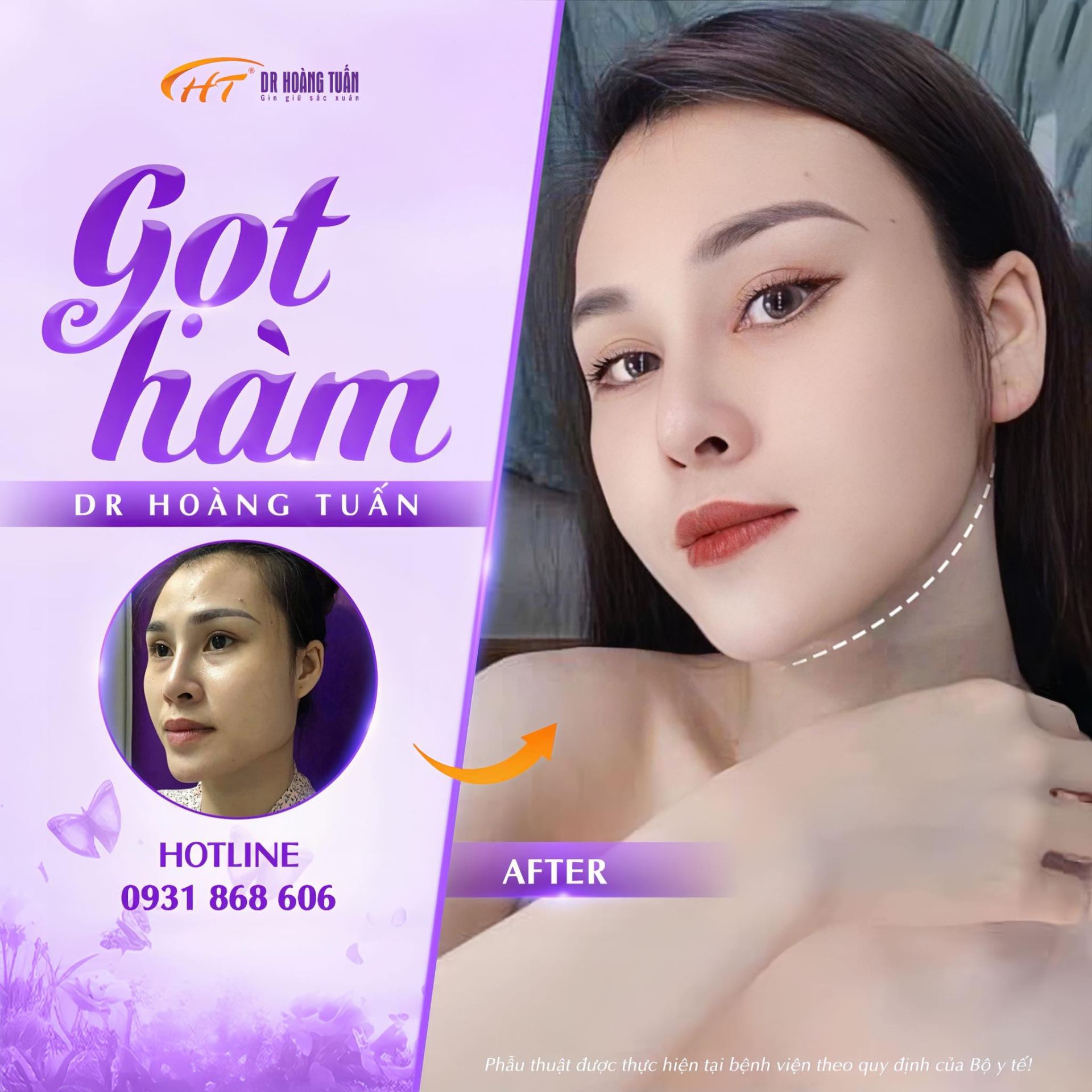 Phẫu thuật tạo h&igrave;nh khu&ocirc;n mặt - Bước ngoặt thay đổi diện mạo từ nền tảng xương h&agrave;m