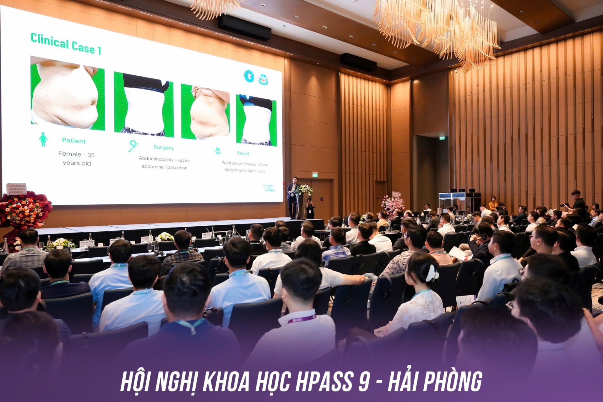 Tạo hình thành bụng
Vòng 2 quá khổ
Phụ nữ
Phẫu thuật
Hoàng Thanh Tuấn