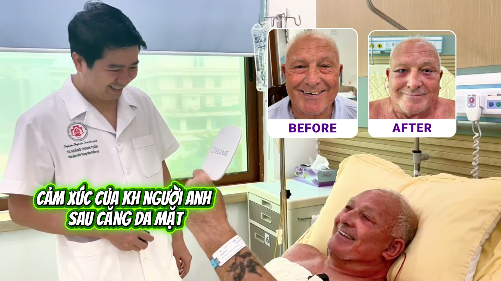 Tiến sĩ, B&aacute;c sĩ Ho&agrave;ng Tuấn căng da mặt cho kh&aacute;ch h&agrave;ng Anh quốc - kết quả sau phẫu thuật 1 ng&agrave;y