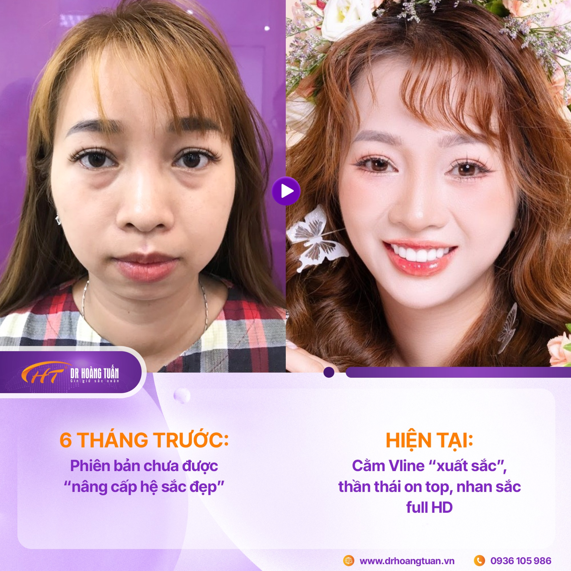 Độn cằm c&oacute; để lại sẹo kh&ocirc;ng? Kh&aacute;m ph&aacute; kỹ thuật &ldquo;giấu sẹo&rdquo; trong thẩm mỹ hiện đại