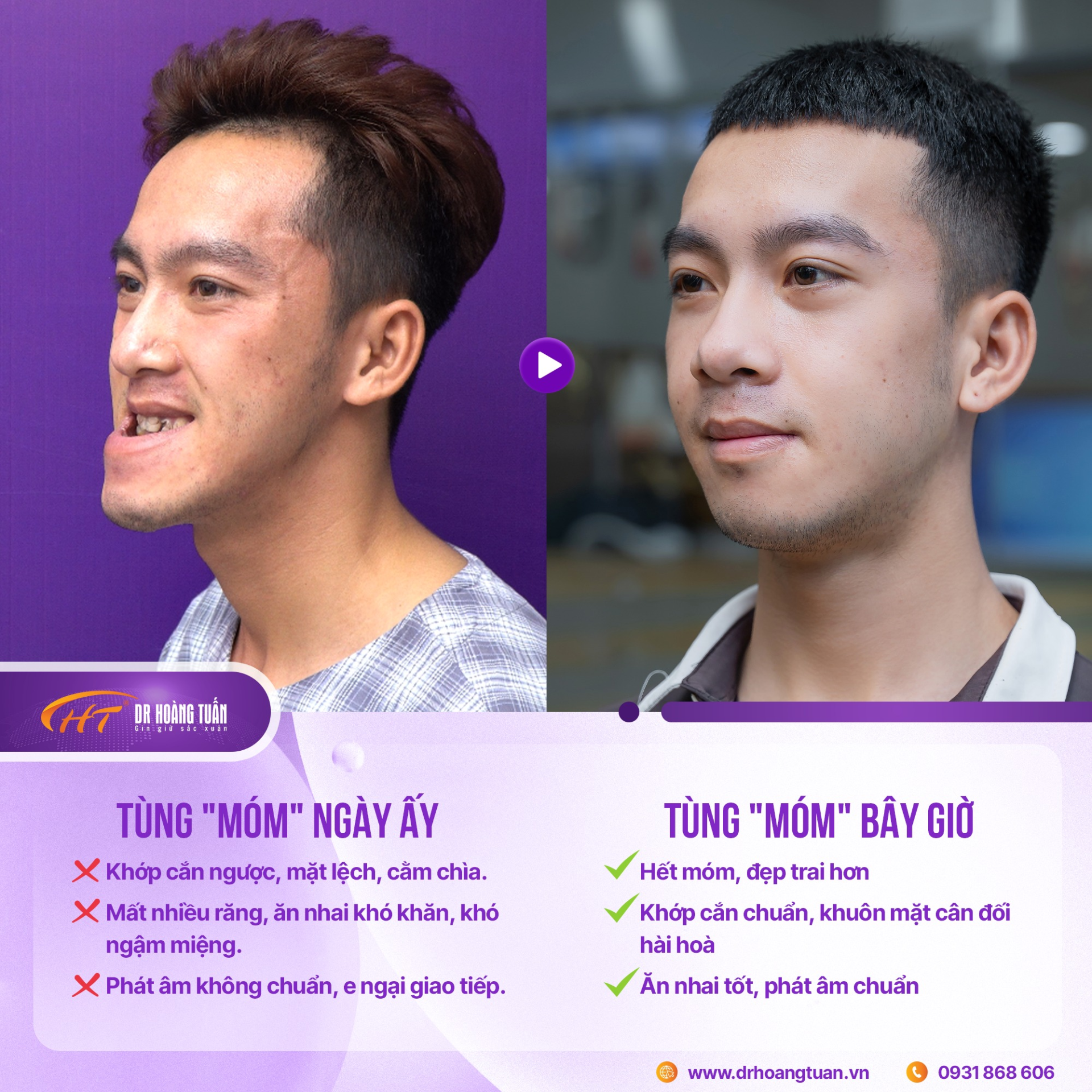 Phẫu thuật tạo h&igrave;nh khu&ocirc;n mặt - Bước ngoặt thay đổi diện mạo từ nền tảng xương h&agrave;m