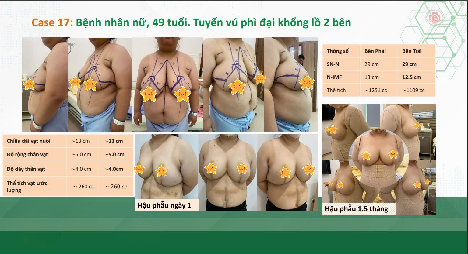 Ngực ph&igrave; đạitreo sa trễTS.BS Ho&agrave;ng Thanh TuấnPhụ nữSự tự tinC&acirc;n đối h&igrave;nh thểChất lượng sống