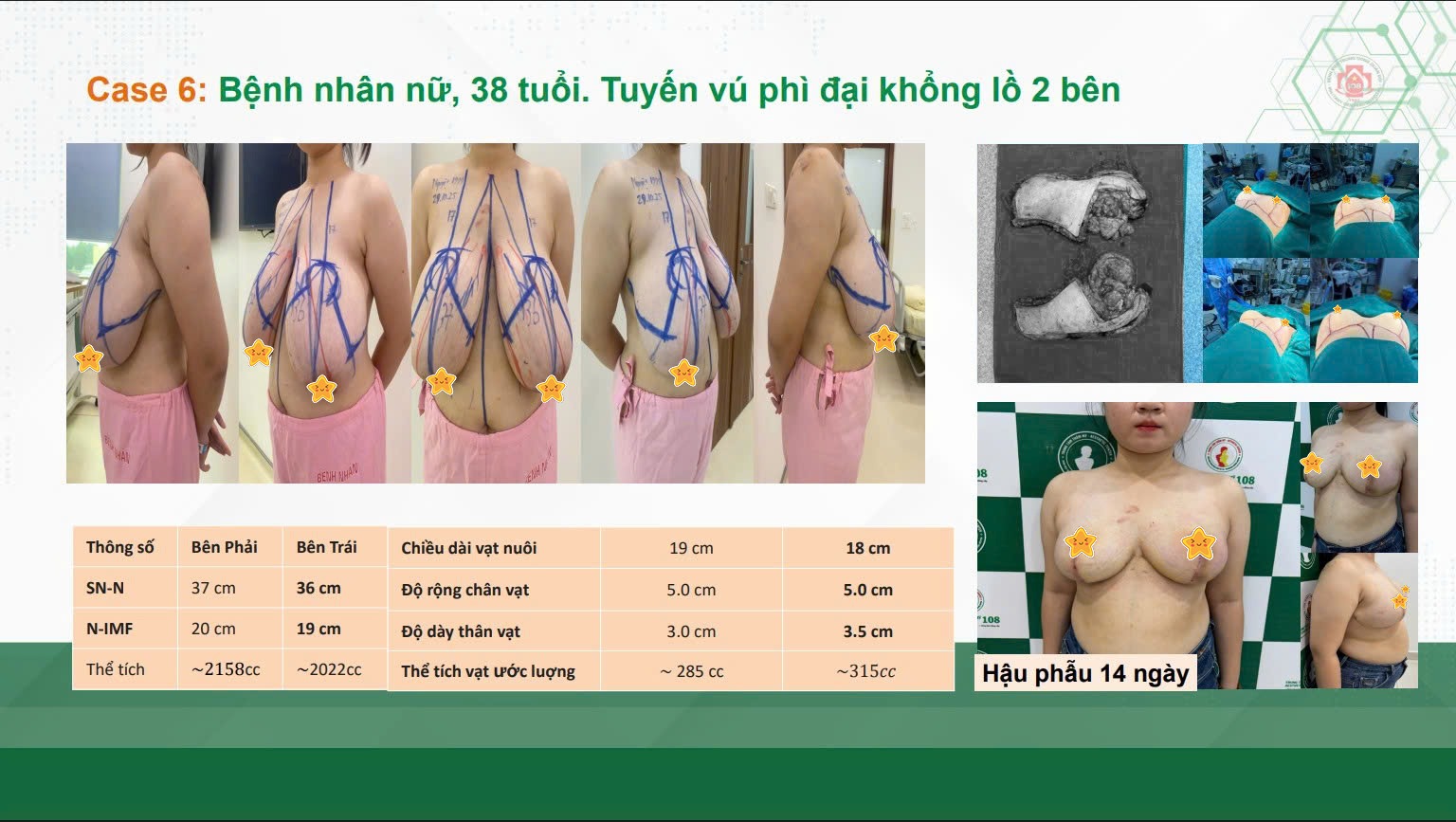 Ngực ph&igrave; đạitreo sa trễTS.BS Ho&agrave;ng Thanh TuấnPhụ nữSự tự tinC&acirc;n đối h&igrave;nh thểChất lượng sống