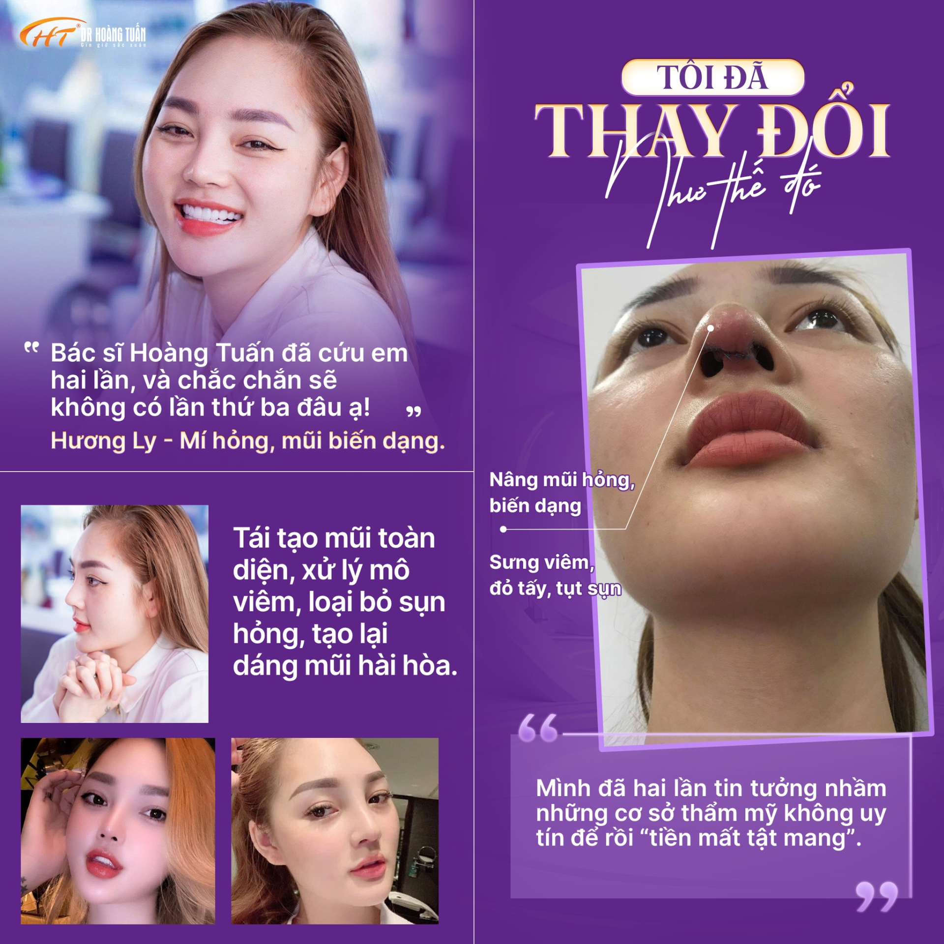 T&Ocirc;I Đ&Atilde; THAY ĐỔI NHƯ THẾ Đ&Oacute;: Hương Ly &ndash; C&ocirc; g&aacute;i v&agrave; hai lần &ldquo;t&aacute;i sinh nhan sắc&rdquo; c&ugrave;ng Dr. Ho&agrave;ng Tuấn