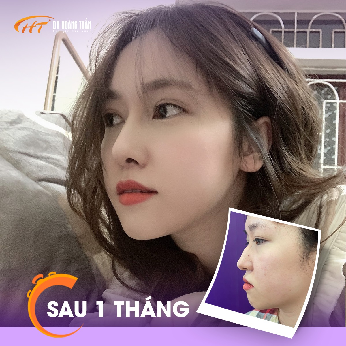 nâng mũi có đau không