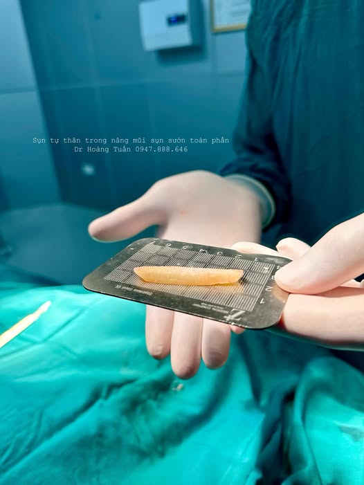 nâng mũi sụn sườn bao lâu thì lành