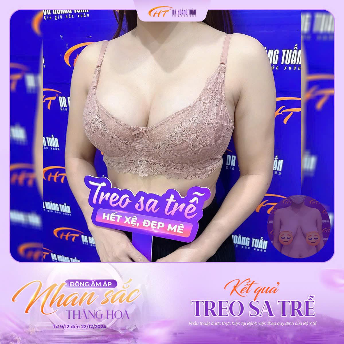 nâng ngực sa trễ có để lại sẹo không