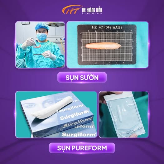 Nâng mũi sụn sườn là gì?