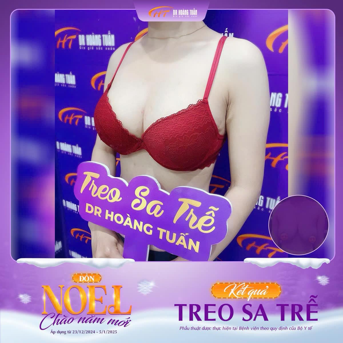 nâng ngực sa trễ có để lại sẹo không