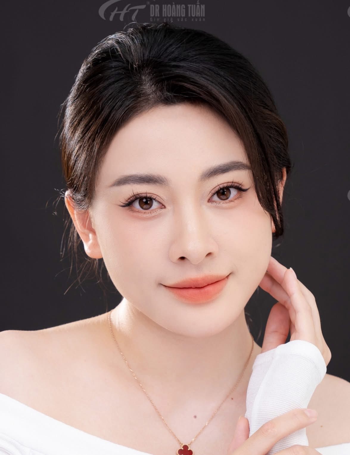 NHẤN MÍ MẮT HẾT SƯNG HOÀN TOÀN SAU MỘT ĐẾN HAI TUẦN