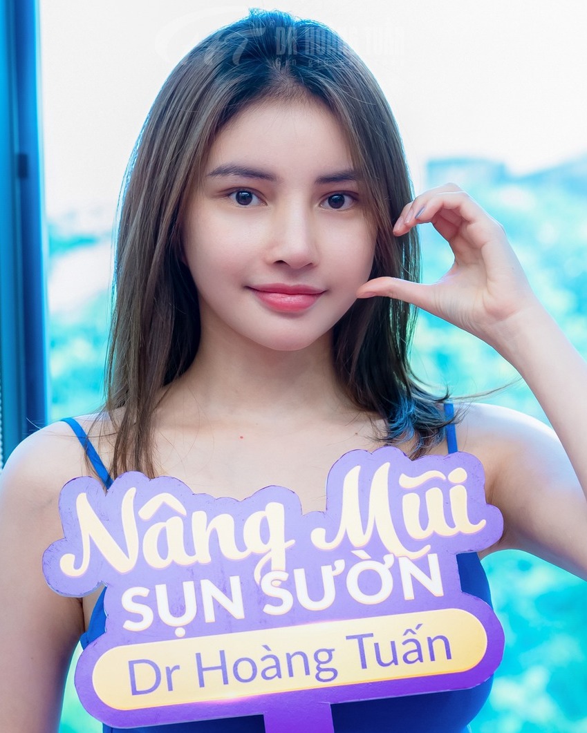 nâng mũi sụn sườn là gì