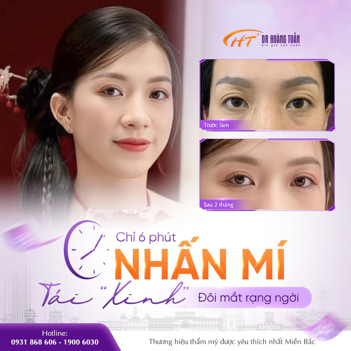 nhấn mí bao lâu thì hồi phục