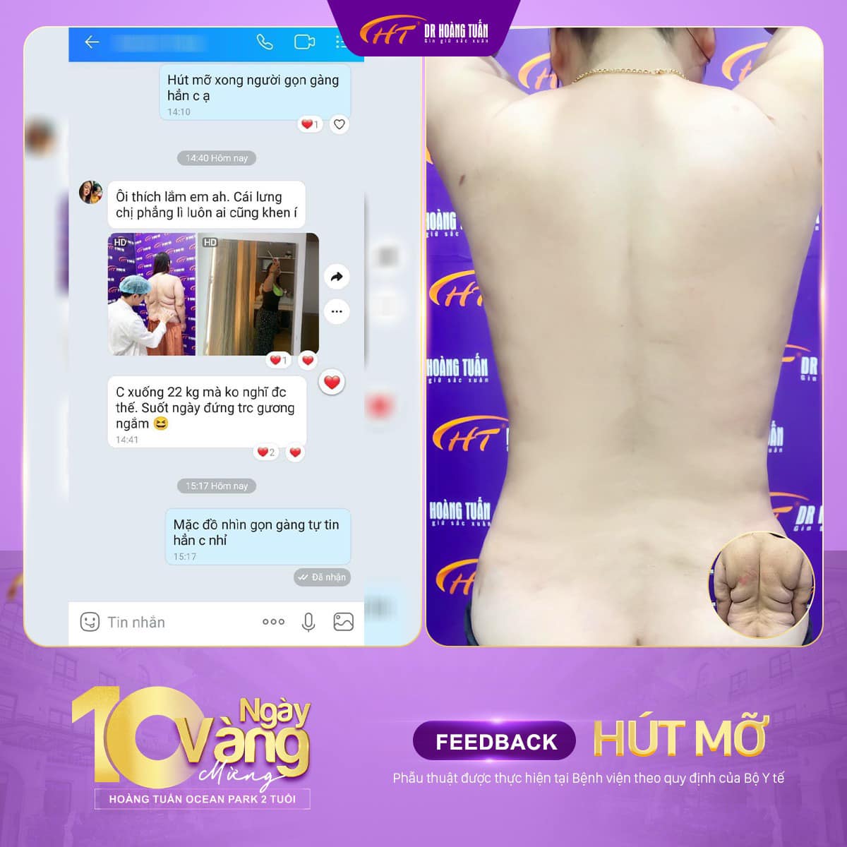 Lợi ích sau khi hút mỡ lưng