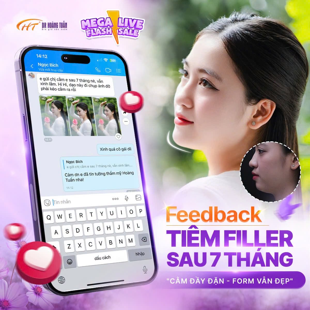 độn cằm rồi c&oacute; ti&ecirc;m filler được kh&ocirc;ng