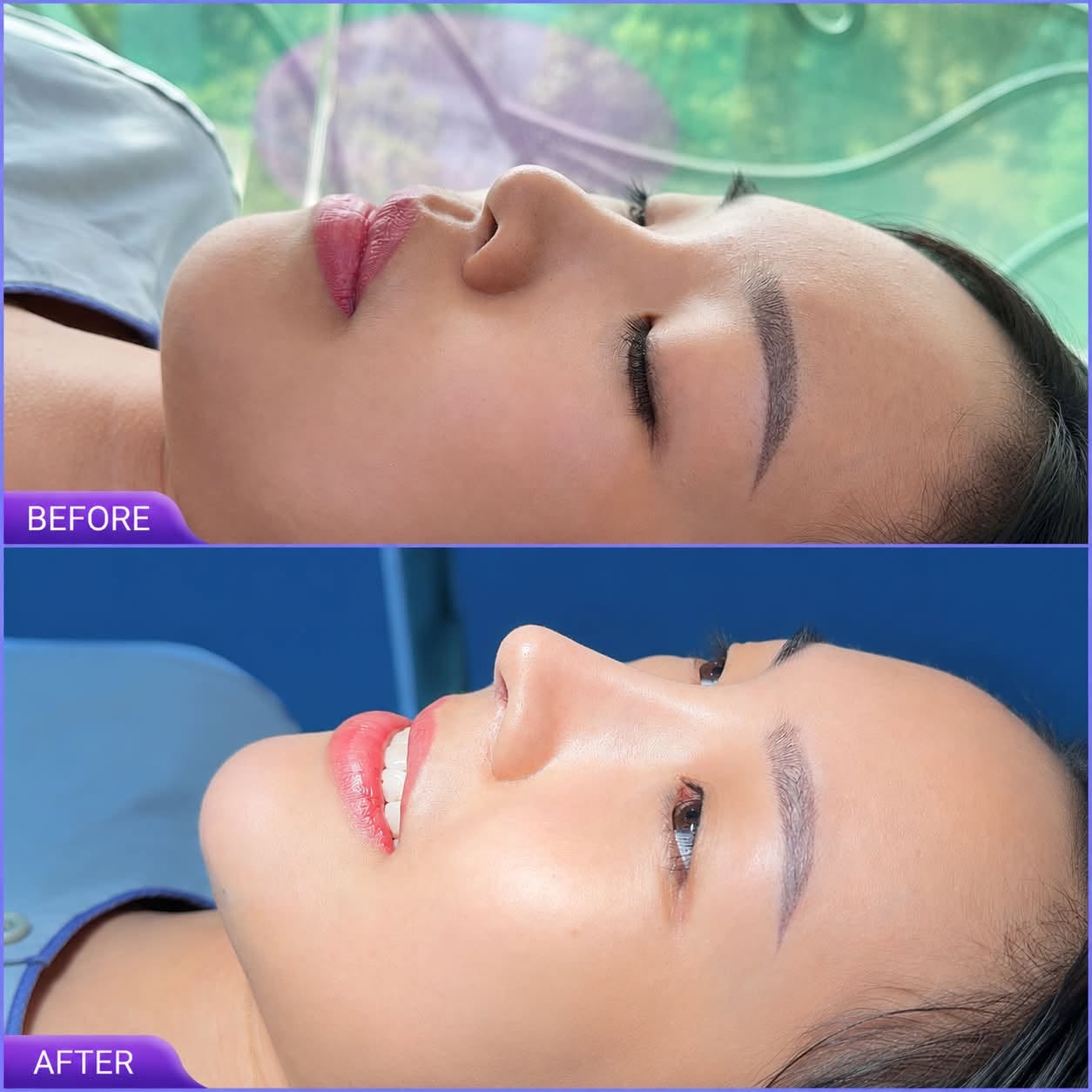 độn cằm rồi c&oacute; ti&ecirc;m filler được kh&ocirc;ng