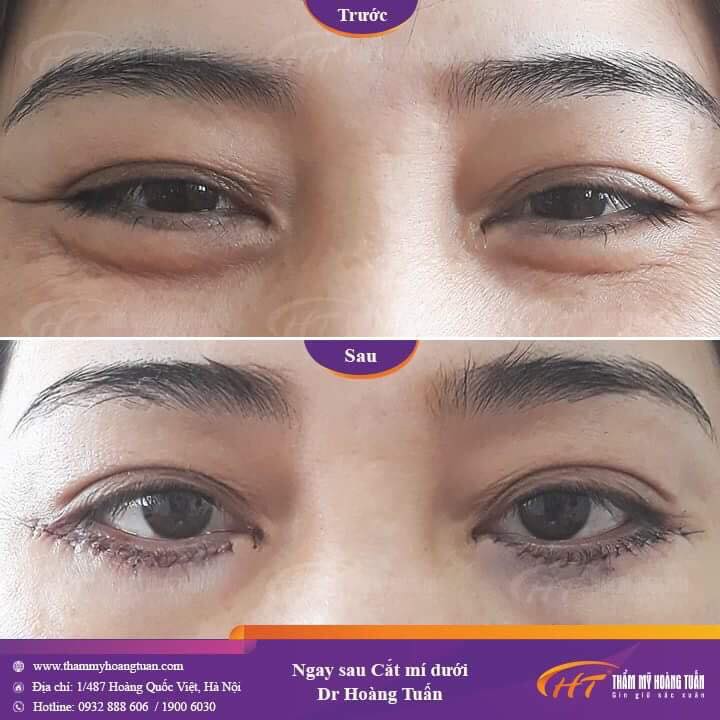 cắt da chùng mí dưới