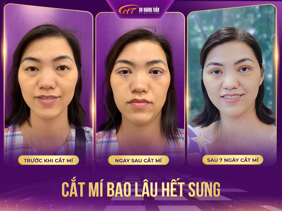 cắt mỡ mắt dưới