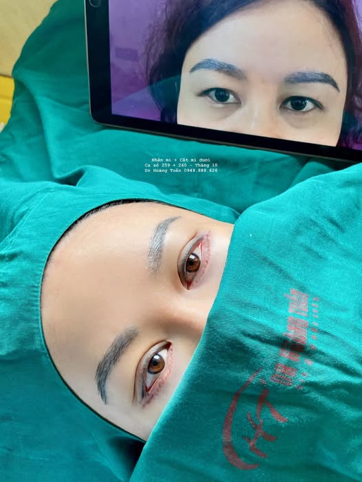 có nên cắt mí dưới không