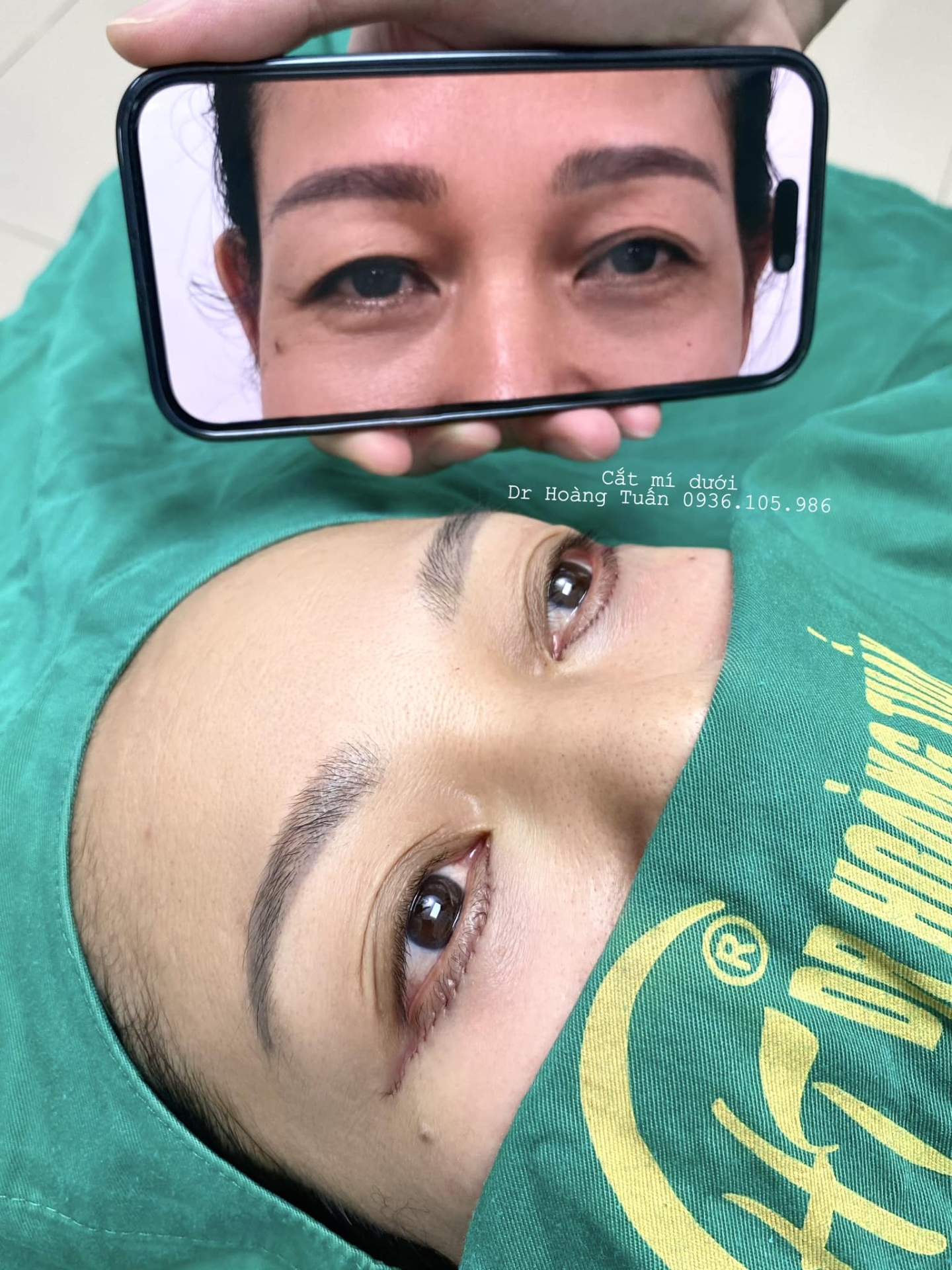 cắt da chùng mí dưới