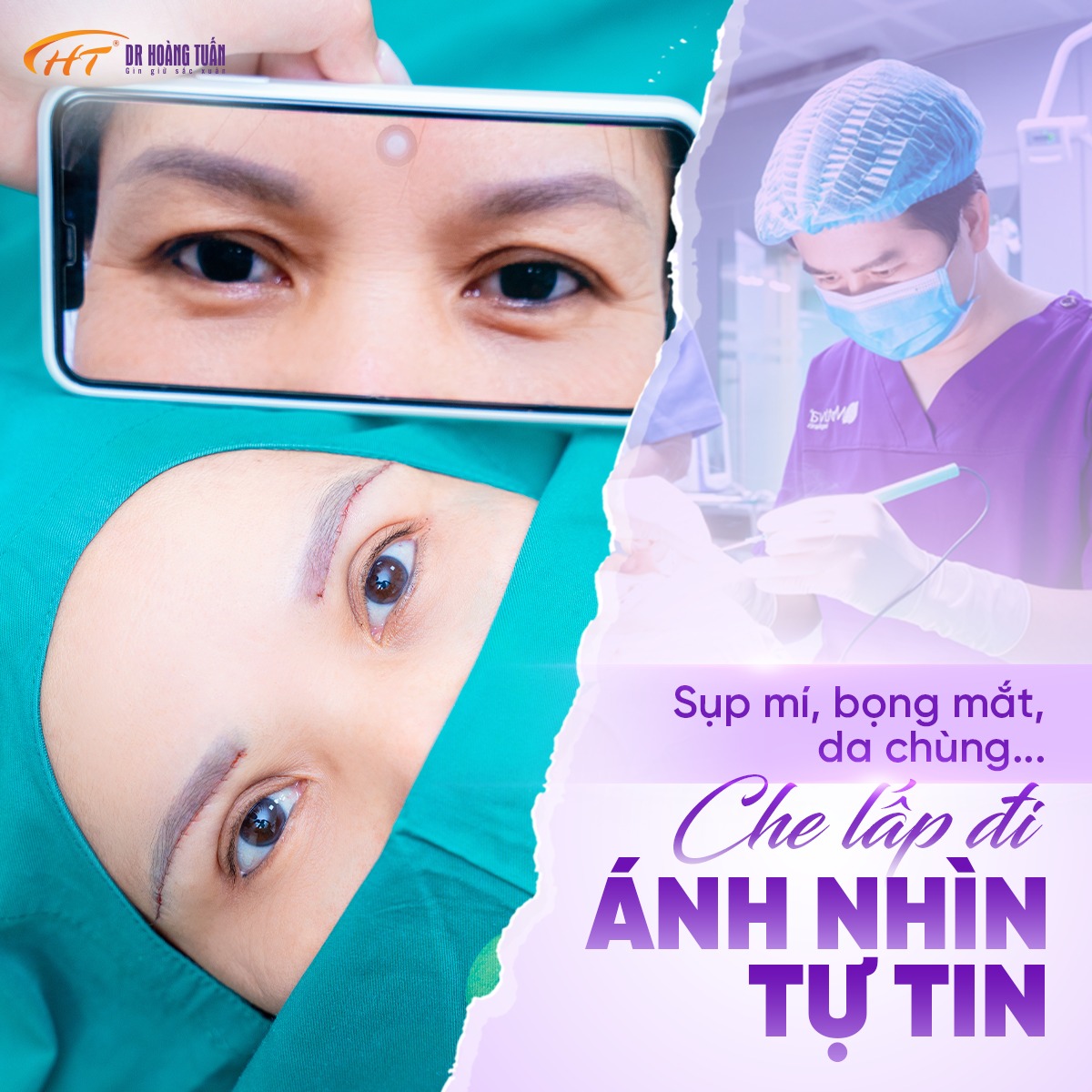 cắt da chùng mí dưới