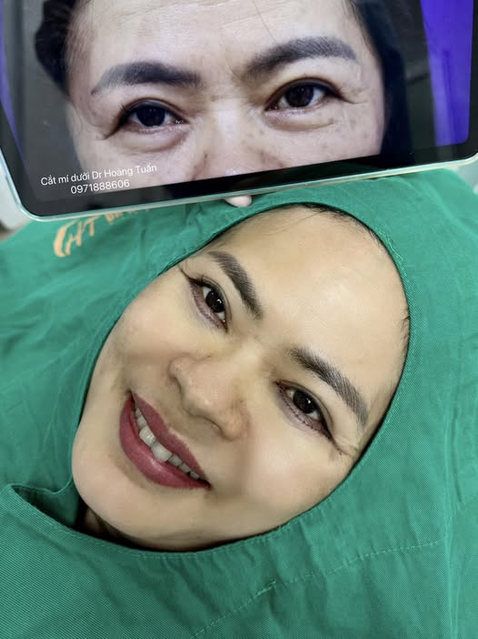 có nên cắt mí dưới không