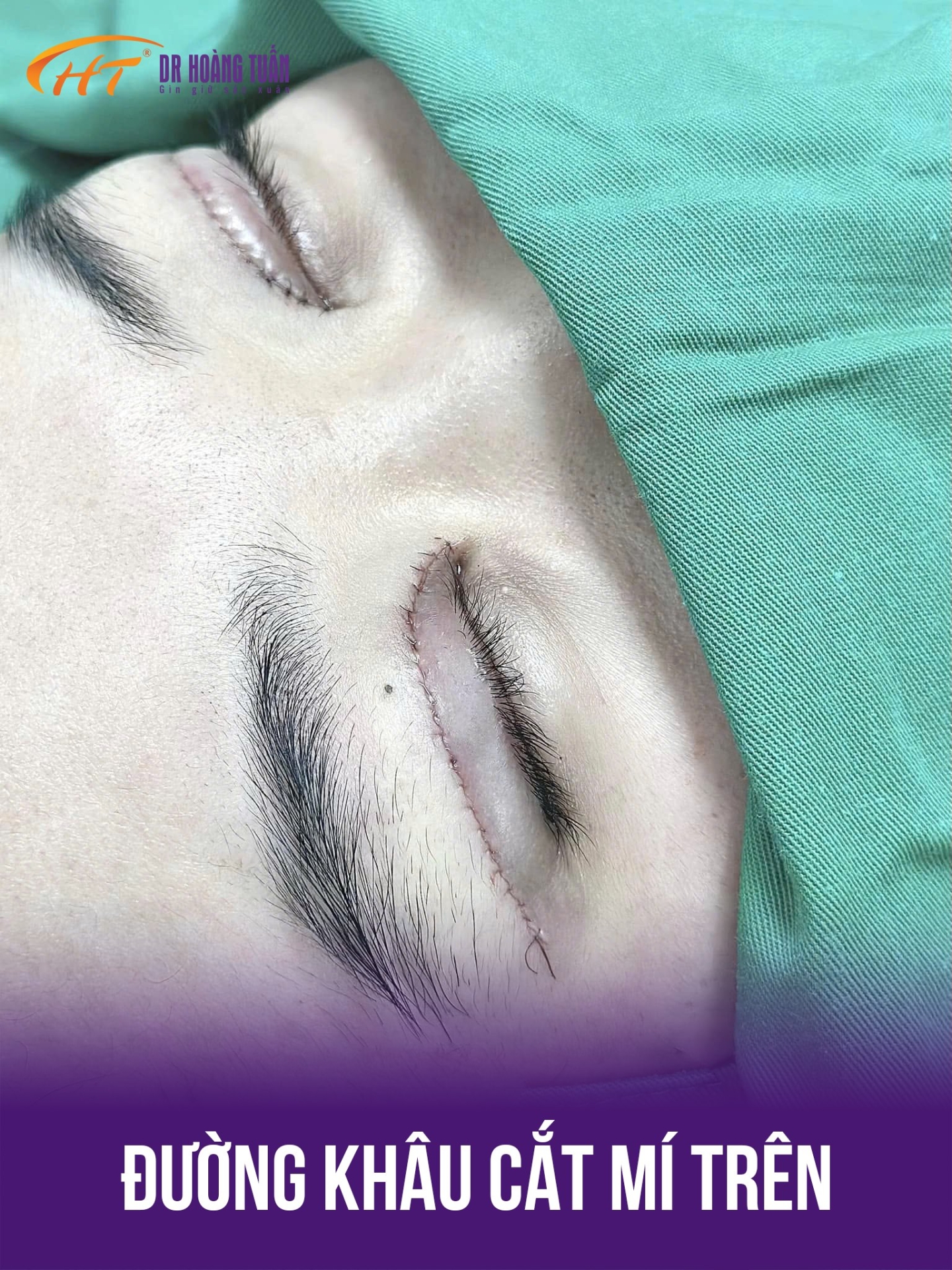 cắt mỡ mí trên