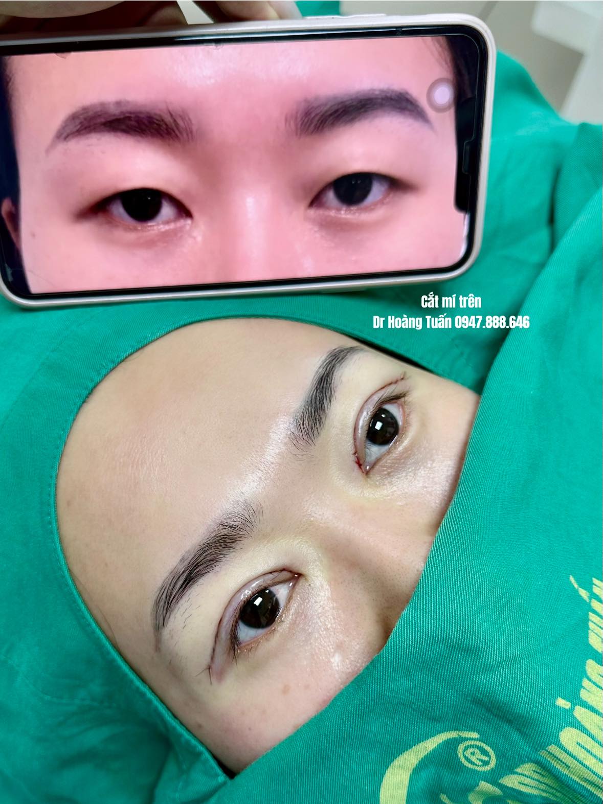 cắt da chùng mí mắt trên