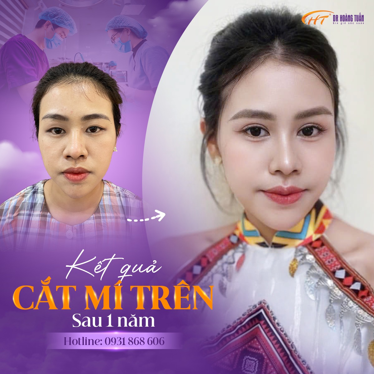 cắt da chùng mí mắt trên