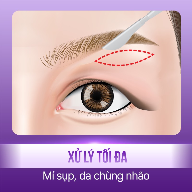 cắt mỡ mí trên