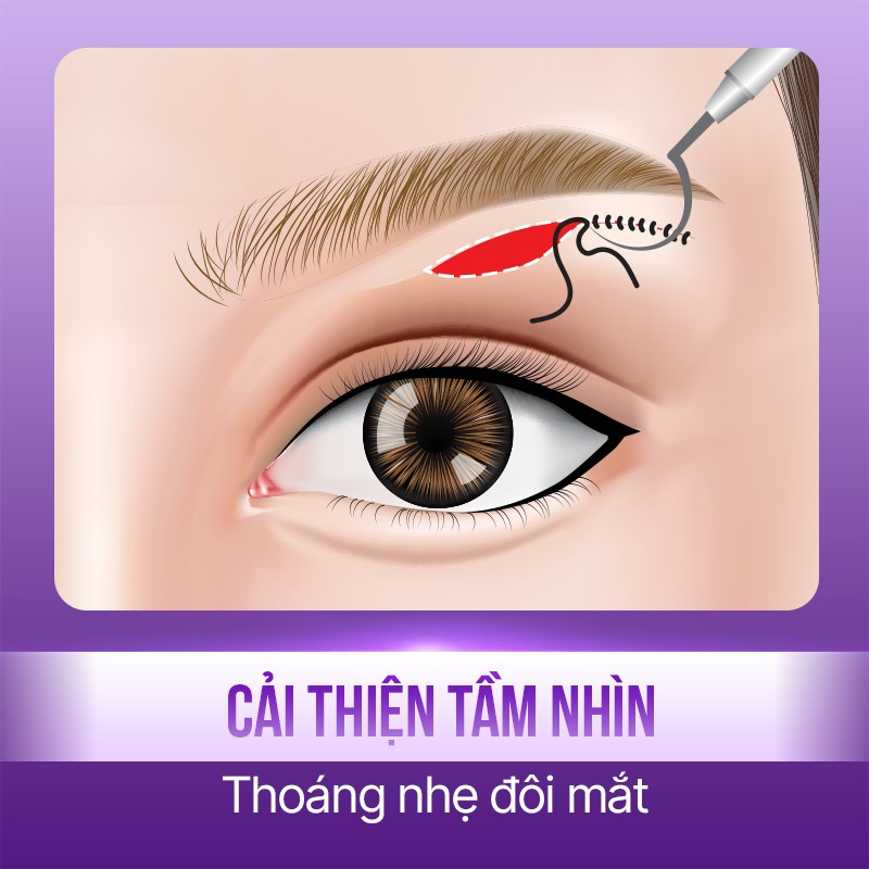 cắt mỡ mí trên
