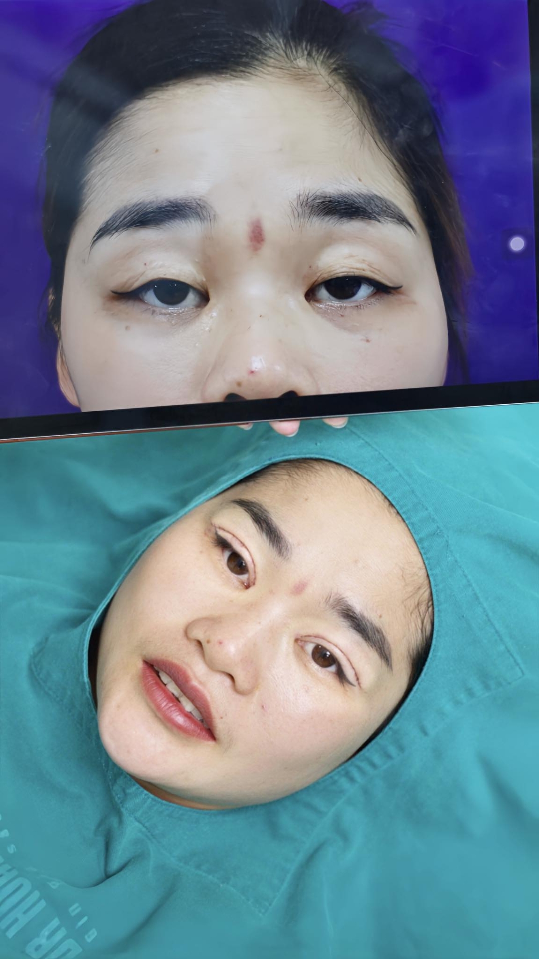 cắt da chùng mí mắt trên