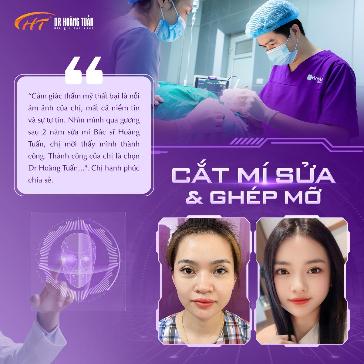 cắt mí mắt không đều