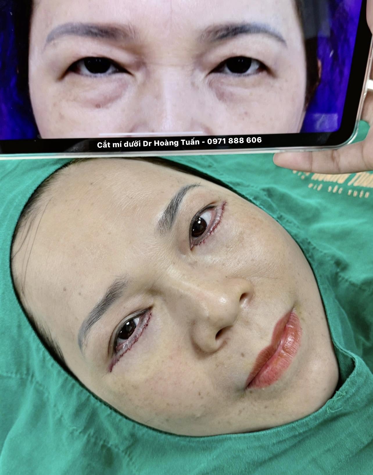 Cắt mí cho người lớn tuổi