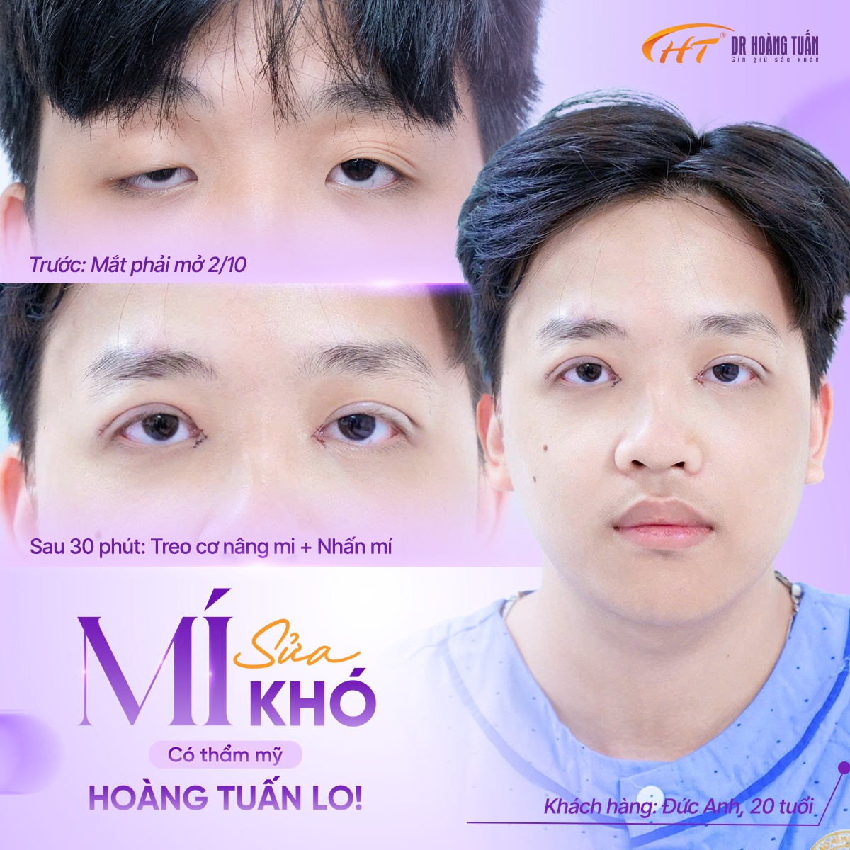 cắt m&iacute; mắt nam
