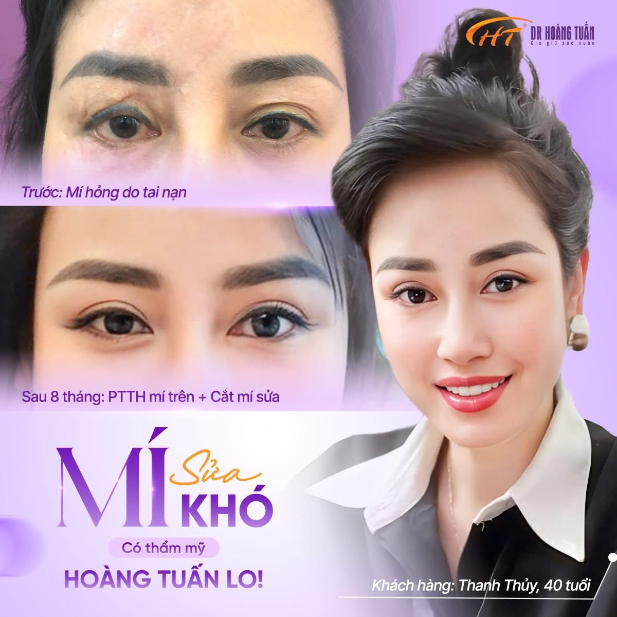 cắt mí hết bao tiền