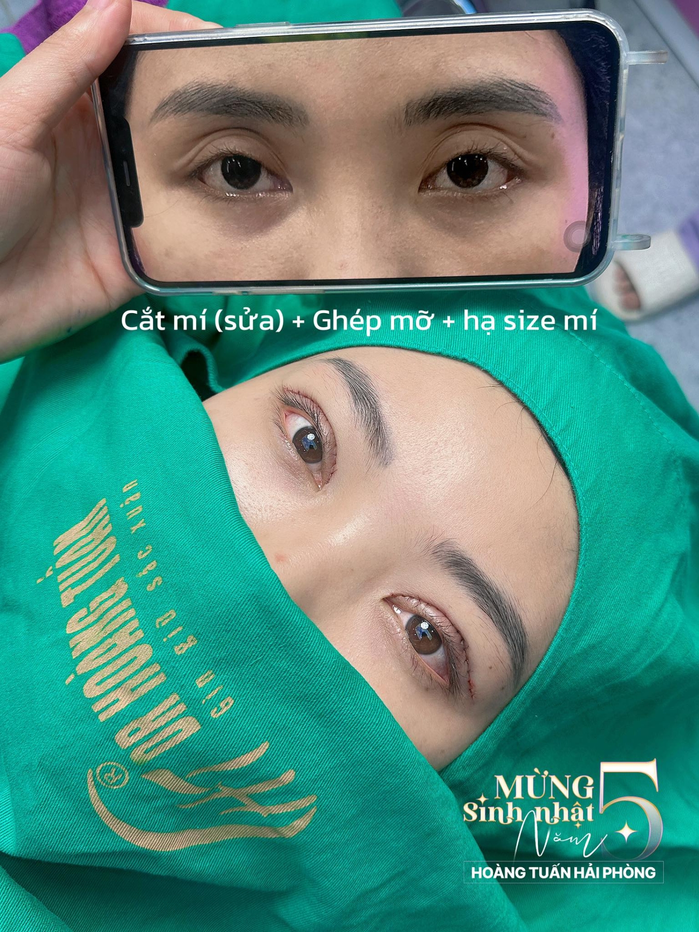 cắt m&iacute; khoảng bao l&acirc;u th&igrave; tự nhi&ecirc;n