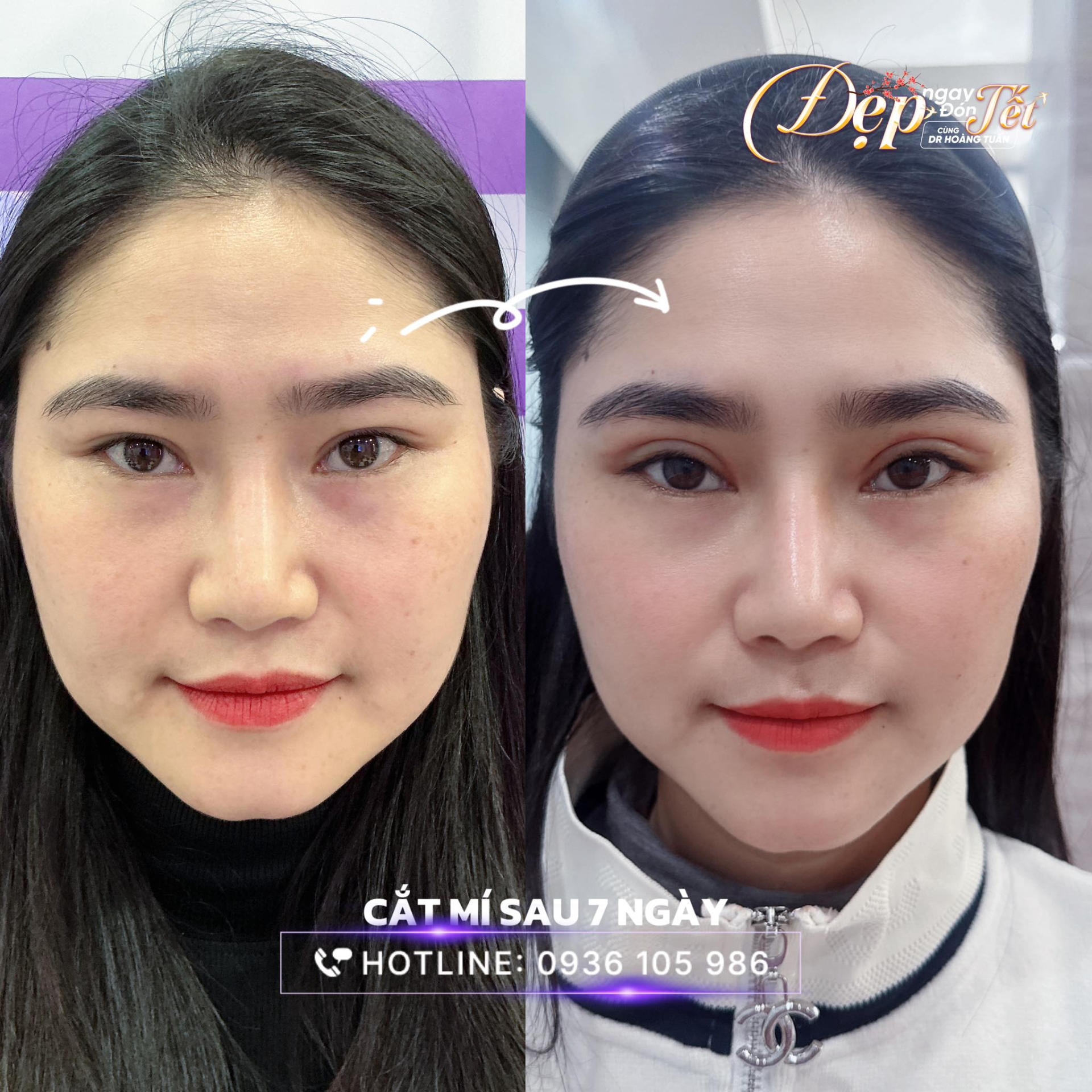 mắt một m&iacute; c&oacute; n&ecirc;n cắt m&iacute; kh&ocirc;ng