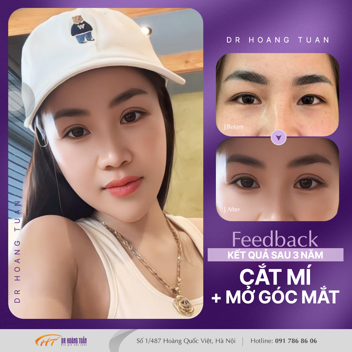 cắt mí hà nội