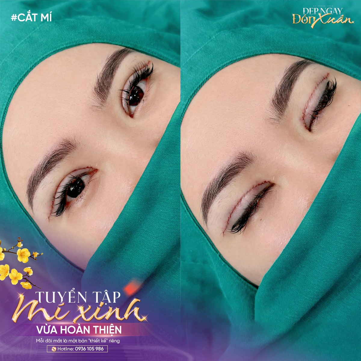 cắt mí sau này có ảnh hưởng gì không