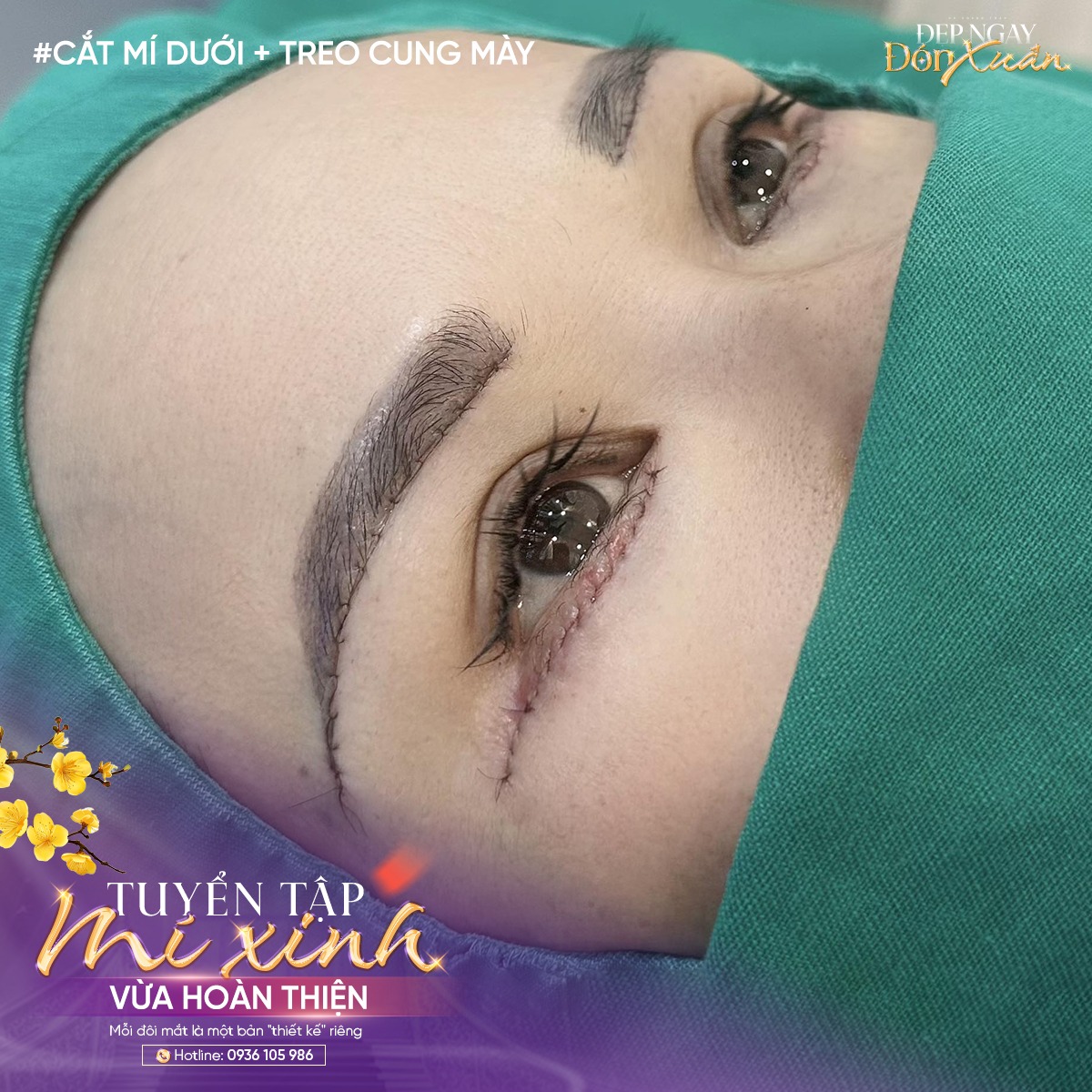 cắt mí có đau không